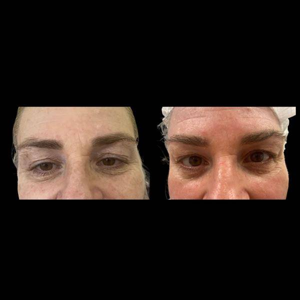 Deep Laser apresenta tratamento inovador para rejuvenescimento do olhar